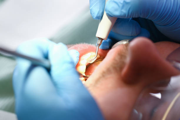 Best Emergency Tooth Extraction in Vinings, GA